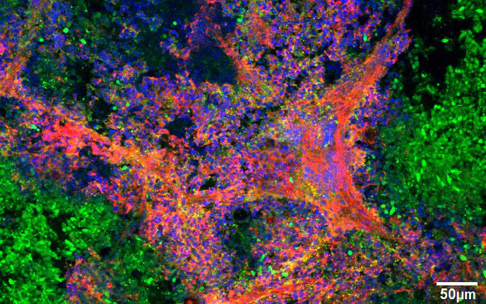 GFP-expressing medulloblastoma organotypic tumor slice culture